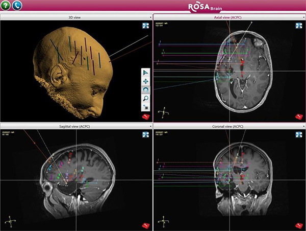 Video EEG Monitoring to Help Understand Brain Fog - Neurology Center For  Epilepsy & Seizures